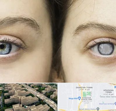 متخصص آب سیاه (گلوکوم) در اکباتان 