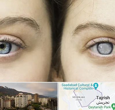 متخصص آب سیاه (گلوکوم) در زعفرانیه 