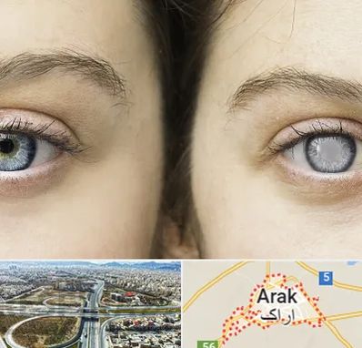 متخصص آب سیاه (گلوکوم) در اراک