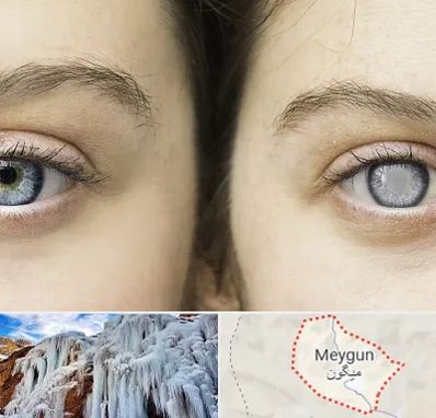 متخصص آب سیاه (گلوکوم) در میگون