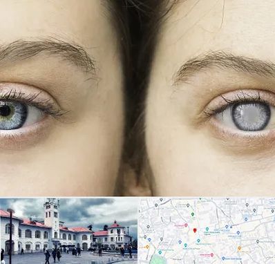 متخصص آب سیاه (گلوکوم) در میدان شهرداری رشت