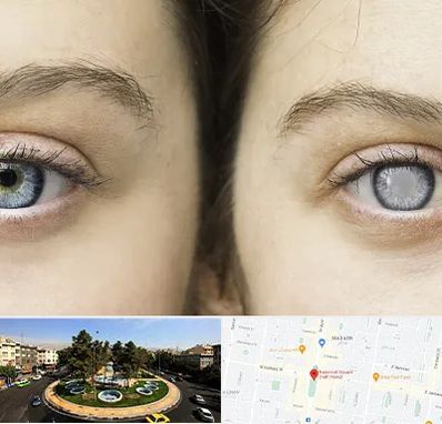 متخصص آب سیاه (گلوکوم) در هفت حوض 