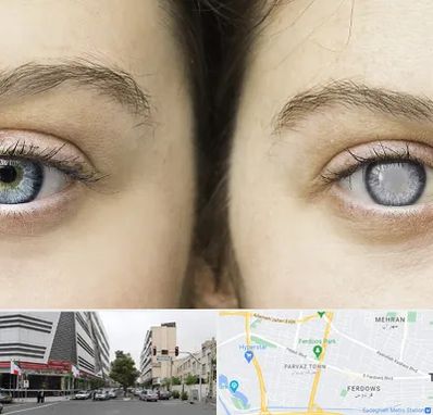 متخصص آب سیاه (گلوکوم) در بلوار فردوس 