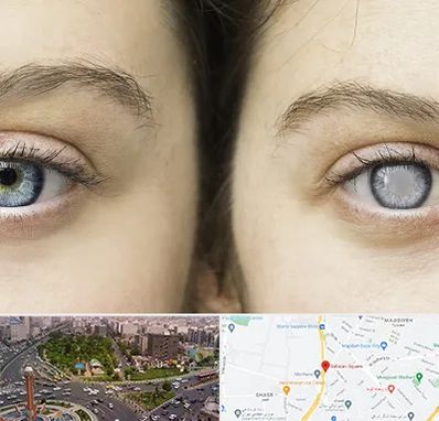 متخصص آب سیاه (گلوکوم) در سبلان 