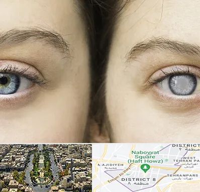 متخصص آب سیاه (گلوکوم) در نارمک 