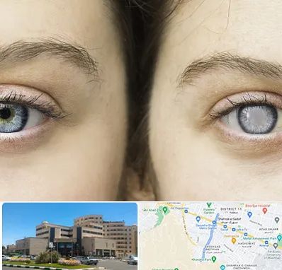 متخصص آب سیاه (گلوکوم) در صیاد شیرازی مشهد