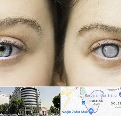 متخصص آب سیاه (گلوکوم) در قلهک 