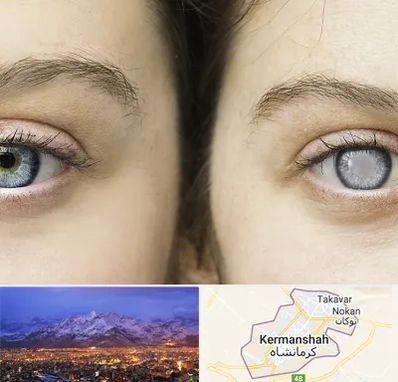 متخصص آب سیاه (گلوکوم) در کرمانشاه