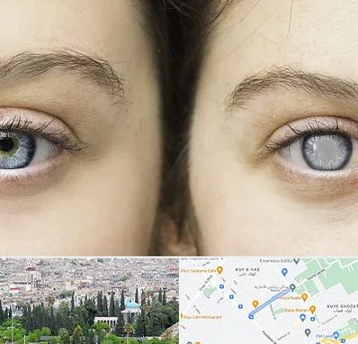 متخصص آب سیاه (گلوکوم) در محلاتی شیراز