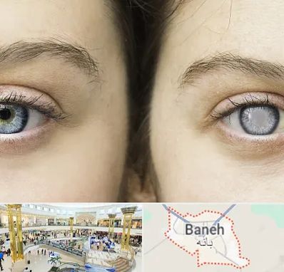 متخصص آب سیاه (گلوکوم) در بانه