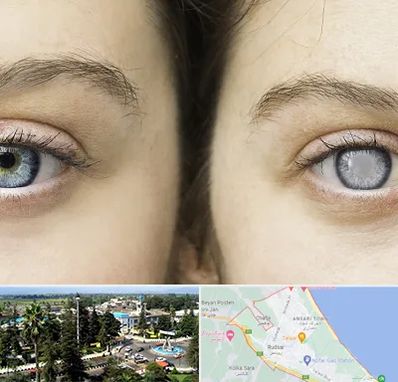 متخصص آب سیاه (گلوکوم) در رودسر