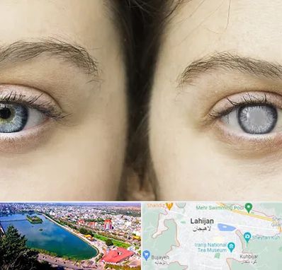 متخصص آب سیاه (گلوکوم) در لاهیجان