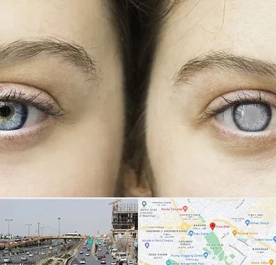 متخصص آب سیاه (گلوکوم) در بلوار توس مشهد 