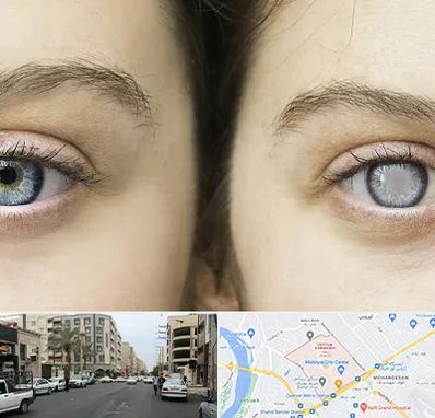 متخصص آب سیاه (گلوکوم) در زیتون کارمندی اهواز