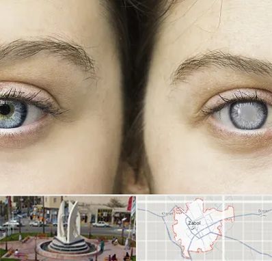 متخصص آب سیاه (گلوکوم) در زابل