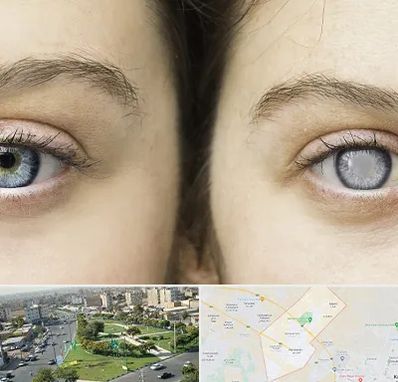 متخصص آب سیاه (گلوکوم) در کمال شهر کرج 