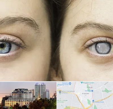 متخصص آب سیاه (گلوکوم) در فرشته 