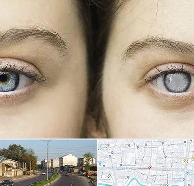 متخصص آب سیاه (گلوکوم) در ضیابری رشت