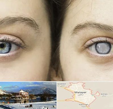 متخصص آب سیاه (گلوکوم) در ملایر