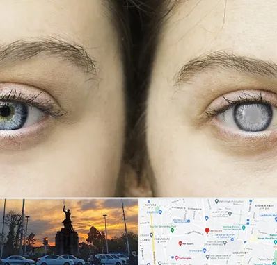 متخصص آب سیاه (گلوکوم) در میدان حر 