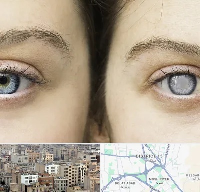 متخصص آب سیاه (گلوکوم) در جنوب شرق تهران