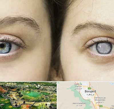 متخصص آب سیاه (گلوکوم) در بروجرد