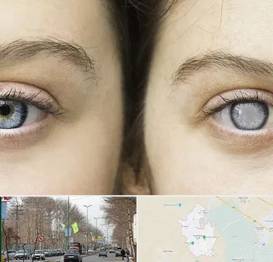 متخصص آب سیاه (گلوکوم) در نظرآباد کرج 