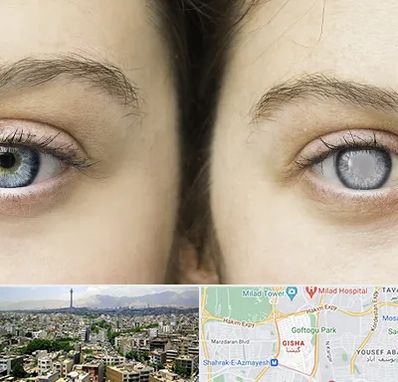 متخصص آب سیاه (گلوکوم) در گیشا 