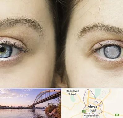 متخصص آب سیاه (گلوکوم) در اهواز