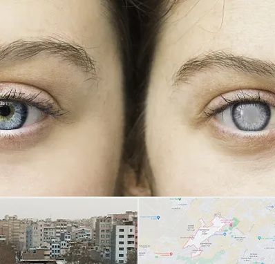 متخصص آب سیاه (گلوکوم) در محمد شهر کرج 