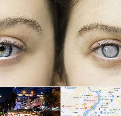 متخصص آب سیاه (گلوکوم) در کیانپارس اهواز