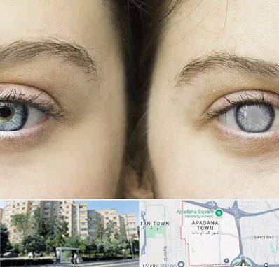 متخصص آب سیاه (گلوکوم) در آپادانا