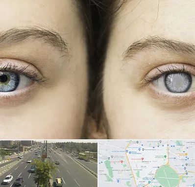 متخصص آب سیاه (گلوکوم) در منطقه 17 تهران 