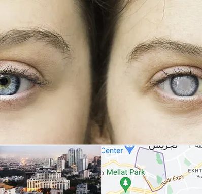 متخصص آب سیاه (گلوکوم) در الهیه 