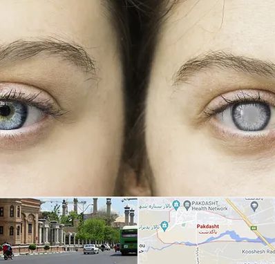 متخصص آب سیاه (گلوکوم) در پاکدشت