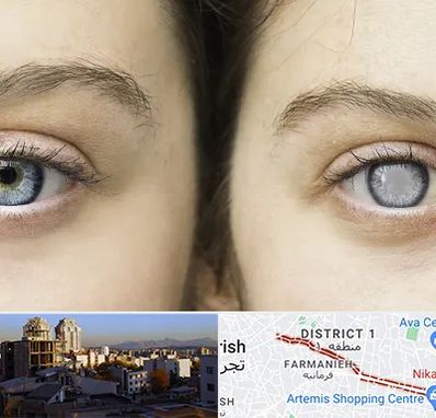 متخصص آب سیاه (گلوکوم) در فرمانیه 