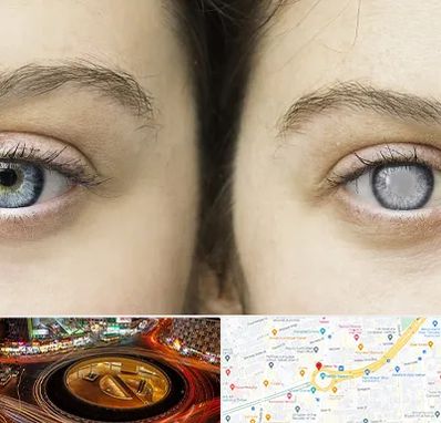 متخصص آب سیاه (گلوکوم) در میدان ولیعصر 