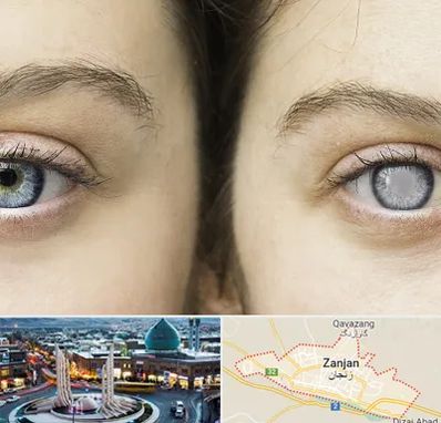 متخصص آب سیاه (گلوکوم) در زنجان