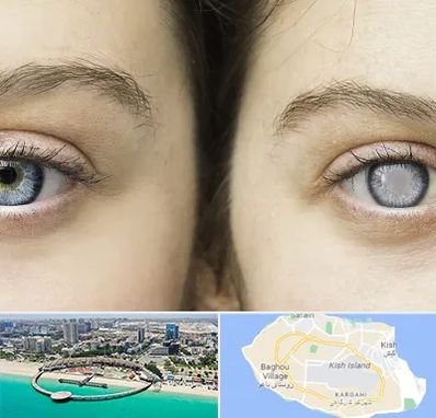 متخصص آب سیاه (گلوکوم) در کیش