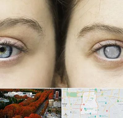 متخصص آب سیاه (گلوکوم) در منطقه 6 تهران 