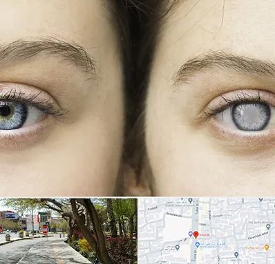 متخصص آب سیاه (گلوکوم) در خیابان توحید اصفهان