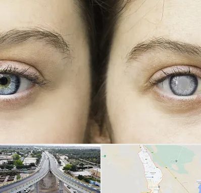 متخصص آب سیاه (گلوکوم) در اندیمشک