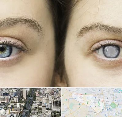 متخصص آب سیاه (گلوکوم) در منطقه 18 تهران 