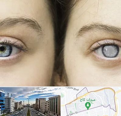 متخصص آب سیاه (گلوکوم) در سعادت آباد 