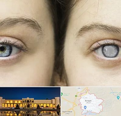 متخصص آب سیاه (گلوکوم) در برازجان