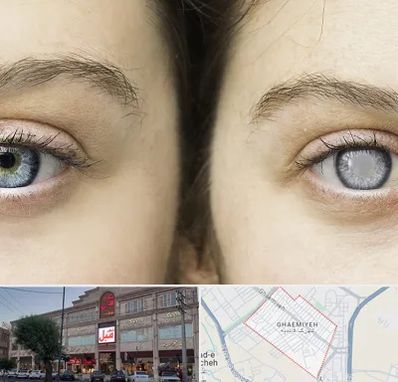 متخصص آب سیاه (گلوکوم) در قائمیه اسلامشهر