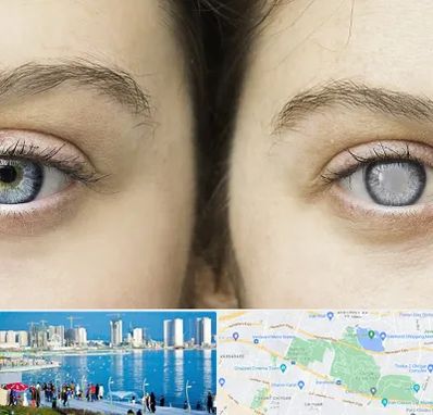 متخصص آب سیاه (گلوکوم) در چیتگر 