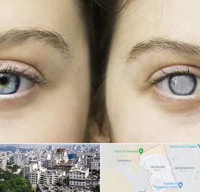 متخصص آب سیاه (گلوکوم) در ولنجک 