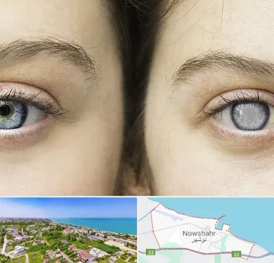 متخصص آب سیاه (گلوکوم) در نوشهر