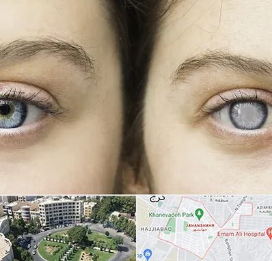 متخصص آب سیاه (گلوکوم) در جهانشهر کرج 